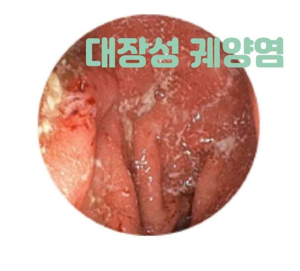 궤양성 대장염 증상과 진단: 의료 전문가의 조언과 경험 공유