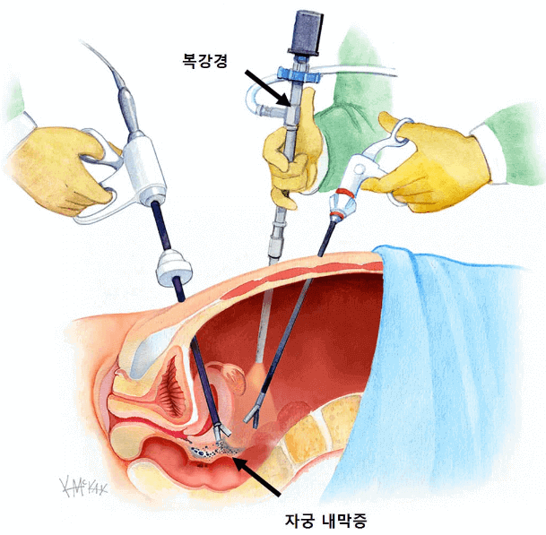 자궁 내막증 원인 치료 검사 임신