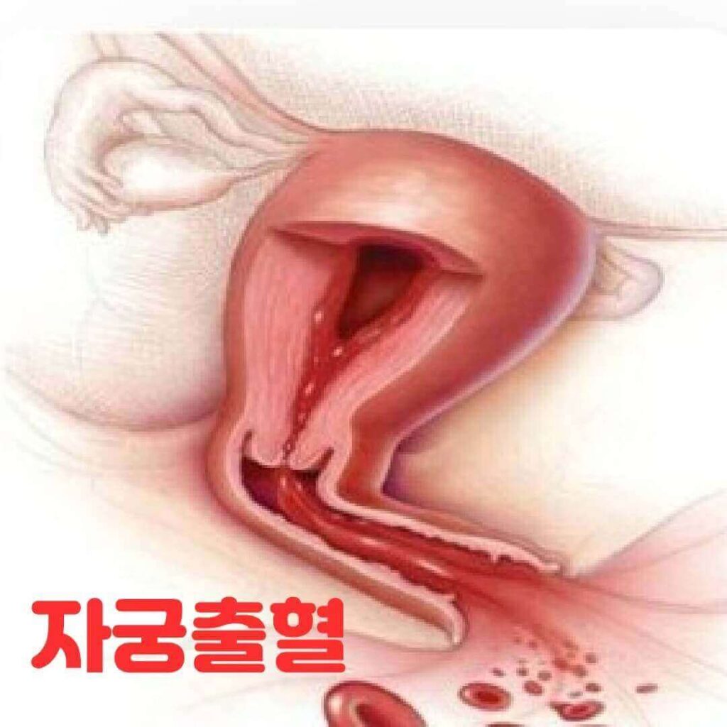 자궁출혈 원인과 증상: 정확한 진단을 위한 안내