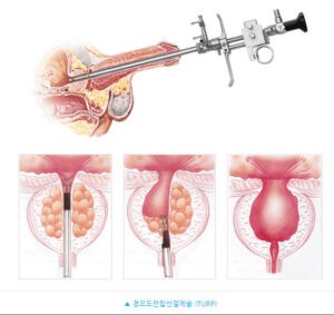 전립선 비대증 치료 수술 식생활 자기관리