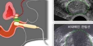 전립선비대증 치료 수술 식생활 자기관리
