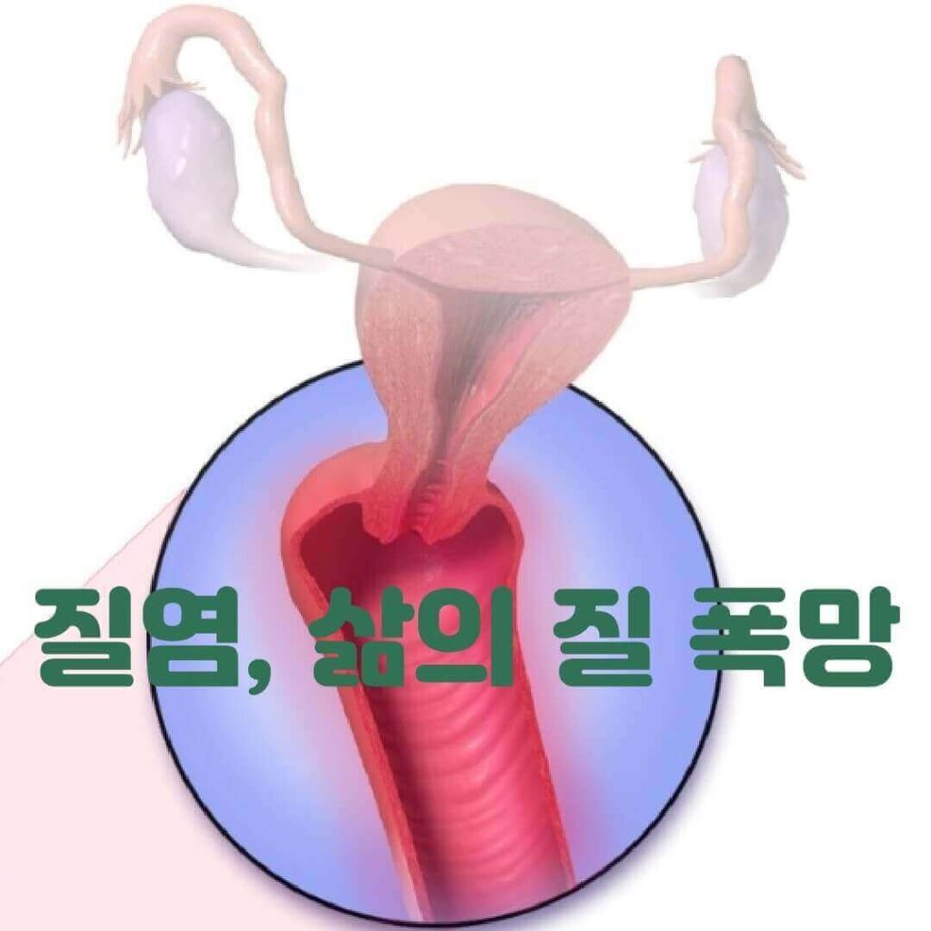 질염 질통증