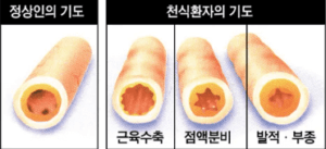 천식 알레르기 자가진단 증상 치료법