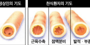 천식 알레르기 자가진단 증상 치료법