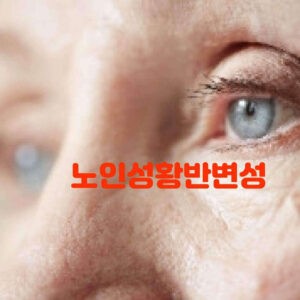 노인성 황반변성 원인 완치 좋은 음식