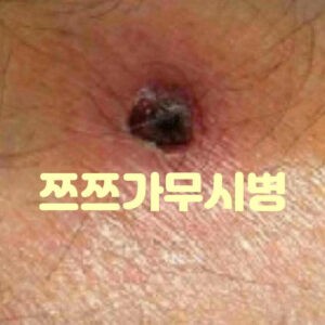 쯔쯔가무시병 살인진드기 유행성출혈열