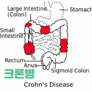 크론병의 식이요법