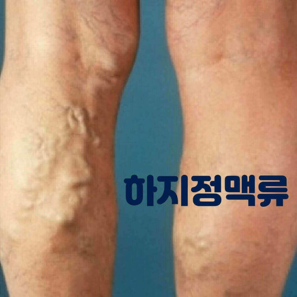 하지정맥류 치료