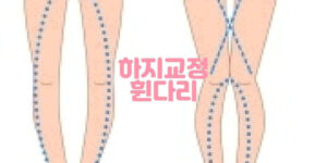 소아 청소년 휜다리 하지교정