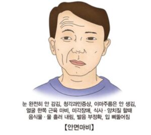 안면 마비