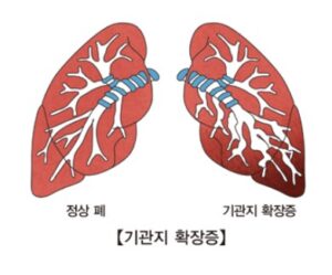 기관지확장증