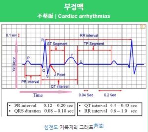 부정맥