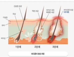 여드름 생성과정