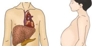 복수 폐수 폐에 물이 차면