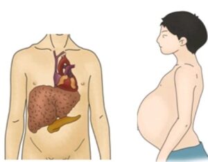 복수 폐수 폐에 물이 차면