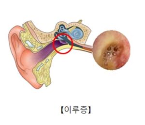 귀 통증