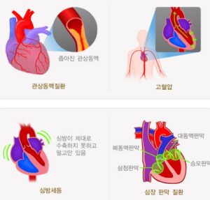 급성 심부전증