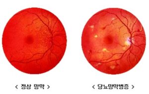 당뇨망막병증