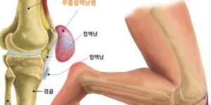 무릎 통증