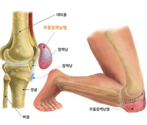 무릎 통증