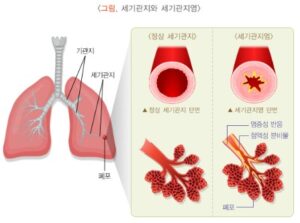 모세기관지염