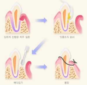 잇몸염증 