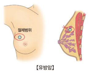 유방암 예방 음식