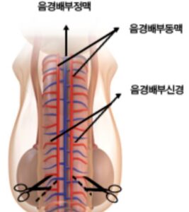 조루증1