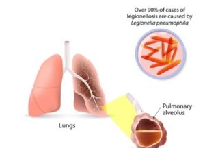 레지오넬라증