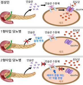 제 2형 당뇨병