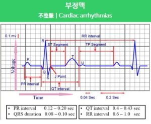 부정맥