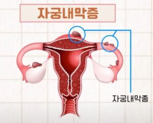 자궁내막증후