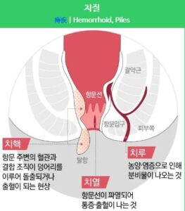 치질