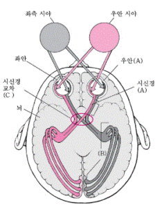 급성 시력상실