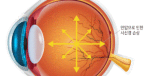 급성 시력상실
