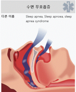 수면무호흡증