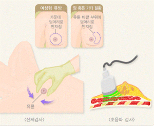 여성형 유방