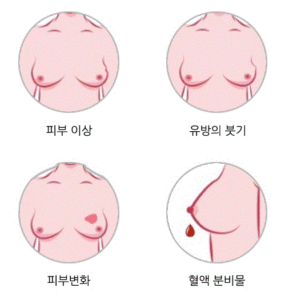 유방 종양