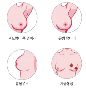 유방 종양