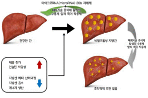 지방간