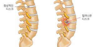 허리 디스크