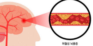 허혈성 뇌졸증