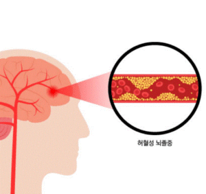 허혈성 뇌졸증